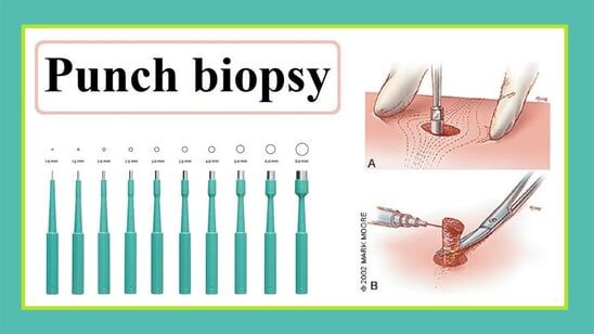Biopsy Punch